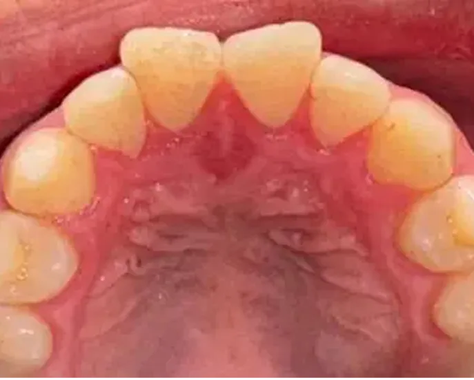 Overhead view of upper dental arch showing teeth arranged in a curved pattern