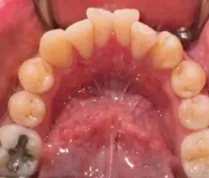 Upper arch of teeth showing crowded alignment before orthodontic treatment