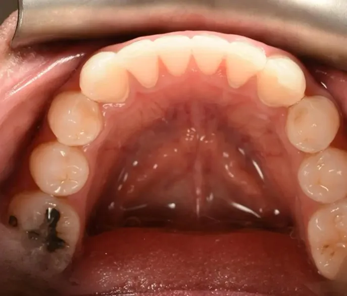 Upper arch of teeth showing improved alignment after Invisalign treatment