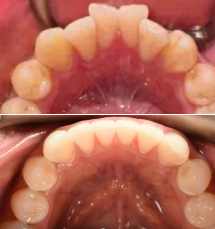 Intraoral before-and-after views of upper and lower teeth showing alignment improvement with Invisalign treatment