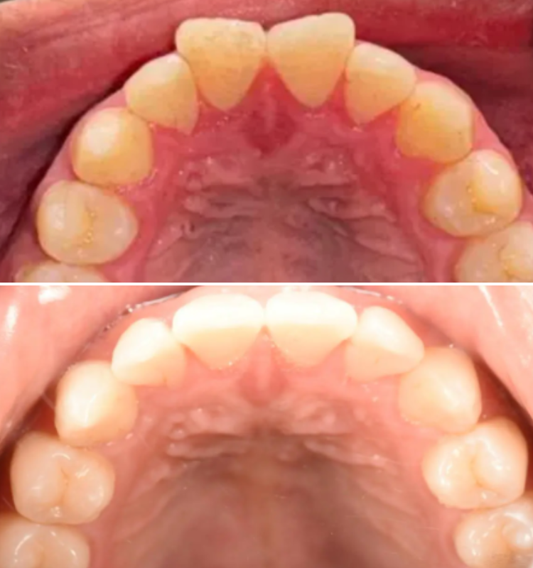 Intraoral before-and-after comparison of upper and lower dental arches demonstrating tooth straightening results