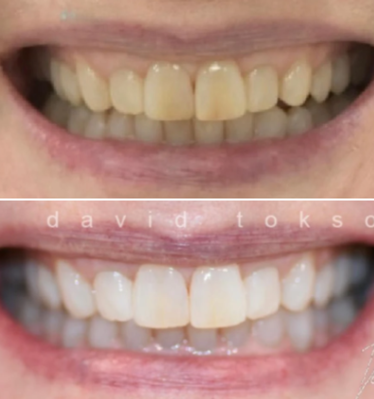 Before-and-after smile showing teeth whitening and alignment improvement with brighter, whiter upper and lower teeth