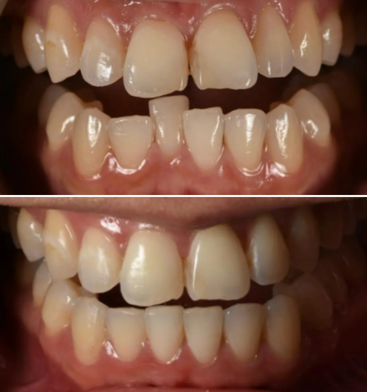 Intraoral before-and-after views of upper and lower teeth showing improved alignment and tooth positioning