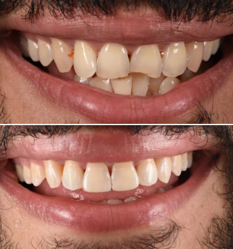 Smile before-and-after comparison displaying whitening results with brighter upper and lower front teeth