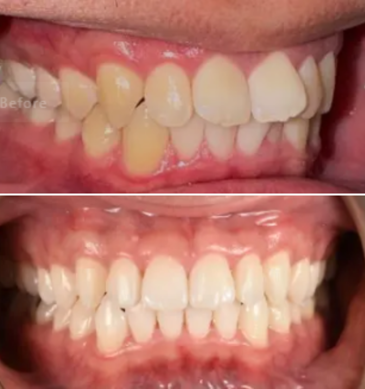 Before-and-after intraoral views labeled 'Before' showing teeth whitening and alignment transformation