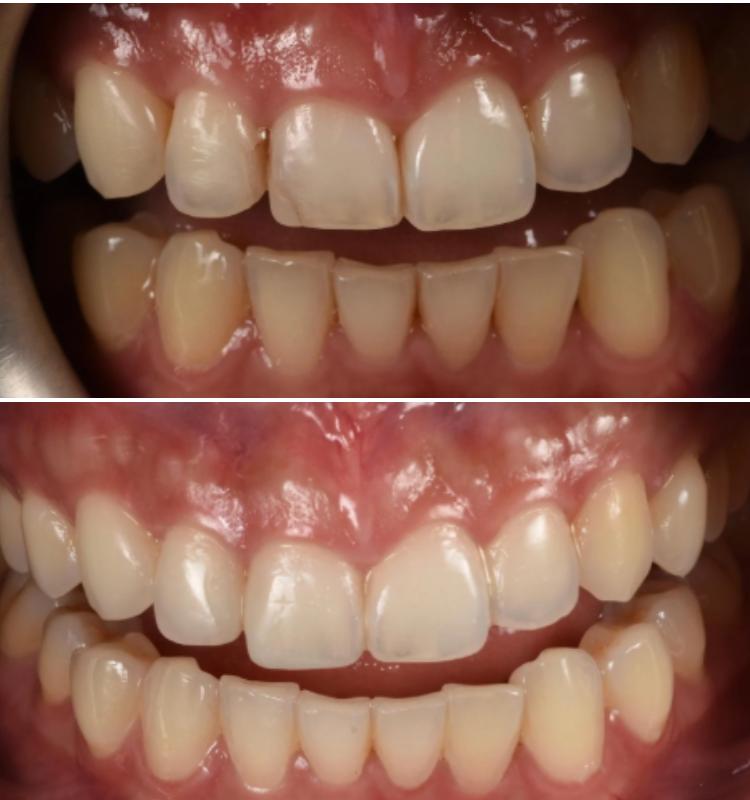 Before and after closeup of upper and lower teeth showing whitening results