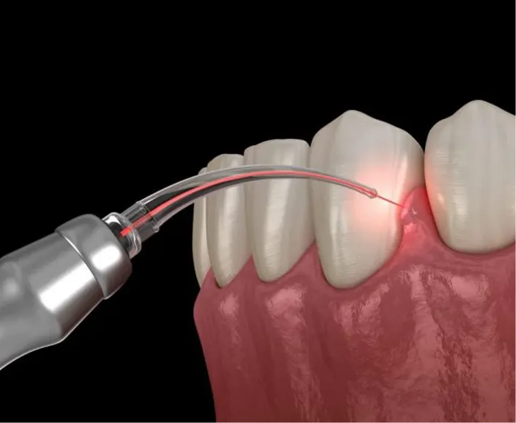 Dental laser device emitting red light beam onto tooth and gum tissue