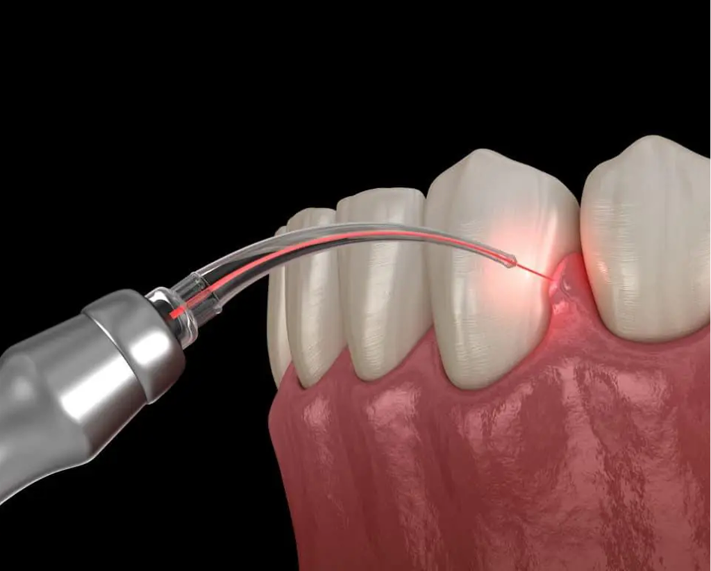 Laser dental tool directing red light beam at teeth and gum tissue during treatment