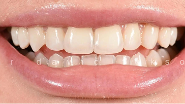 Close-up of dental restoration showing aligned upper and lower front teeth