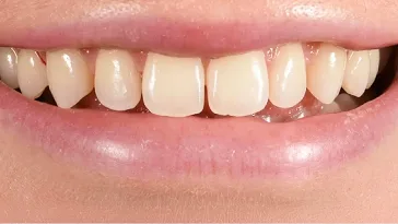 Close-up of natural-looking dental restoration on upper front teeth