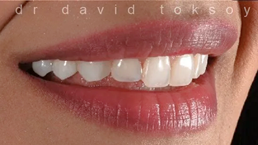 Close-up of a person's smile showing natural-looking teeth with subtle shading variation