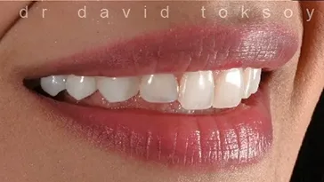 Close-up of a person's smile showing natural-looking teeth with subtle shading variation