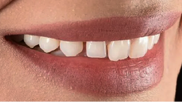 Close-up of a person's smile displaying white teeth against natural lip color