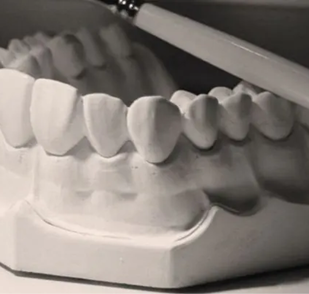 Dental crowns displayed on a white model showing minimally invasive tooth restoration