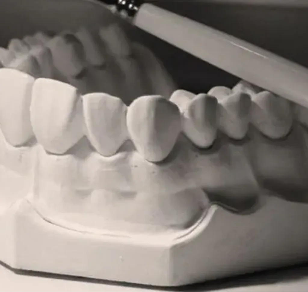 Dental crowns displayed on a white model showing minimally invasive tooth restoration