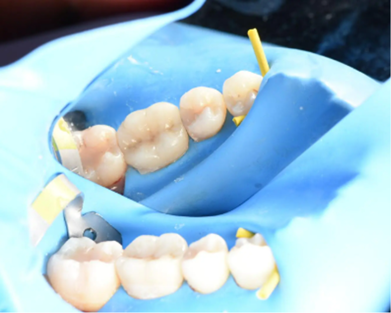 Dental model showing upper and lower teeth with tooth-colored restorations on blue tray
