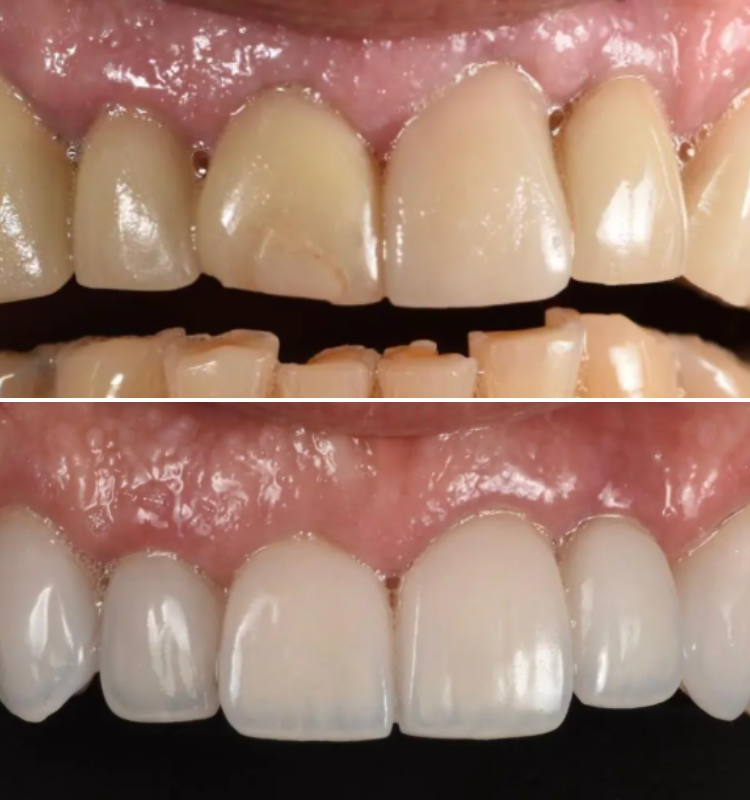 Before and after porcelain veneers on upper and lower front teeth showing enhanced brightness