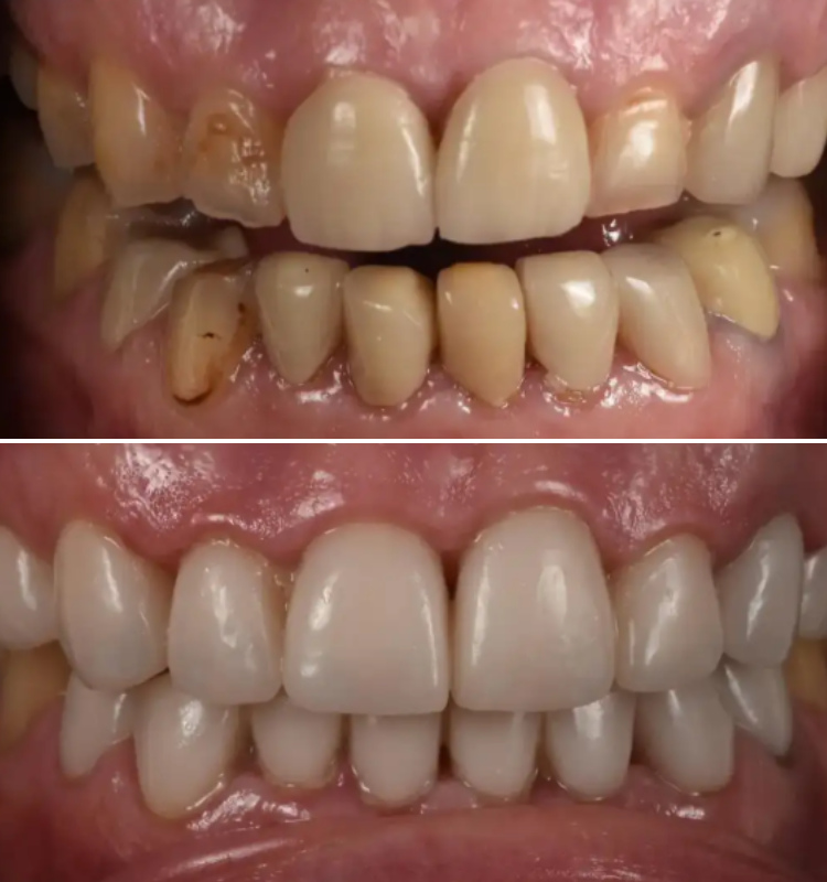 Before and after porcelain veneers showing misaligned teeth transformed to uniform, bright smile