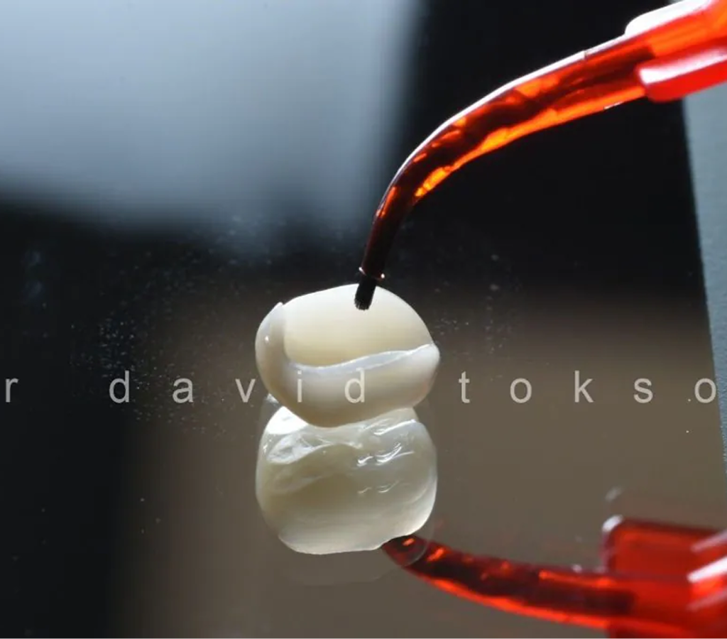 Dental restoration material being applied with a red instrument to a tooth model