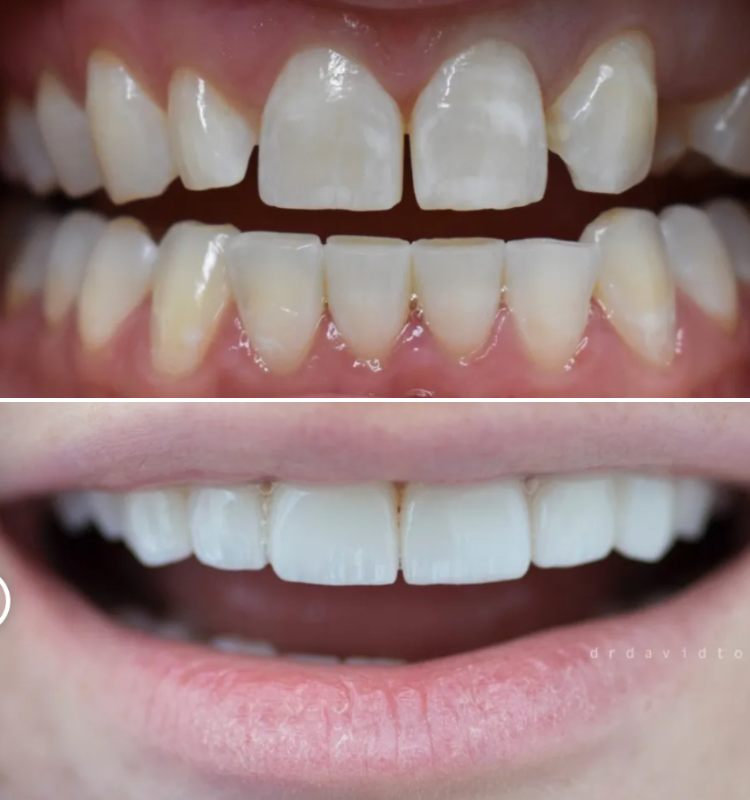 Before and after smile design showing discolored teeth transformed to bright white