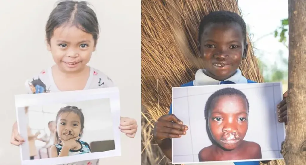 Four children smiling and holding photographs showing before-and-after dental transformations