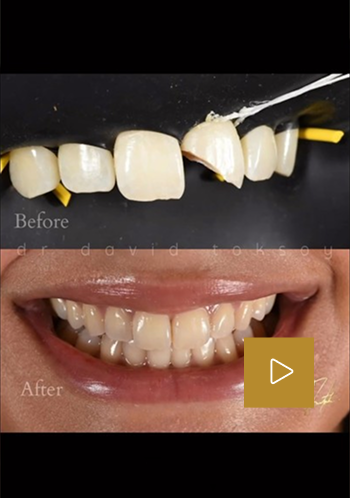 Before and after comparison of teeth whitening with shade guide and play button