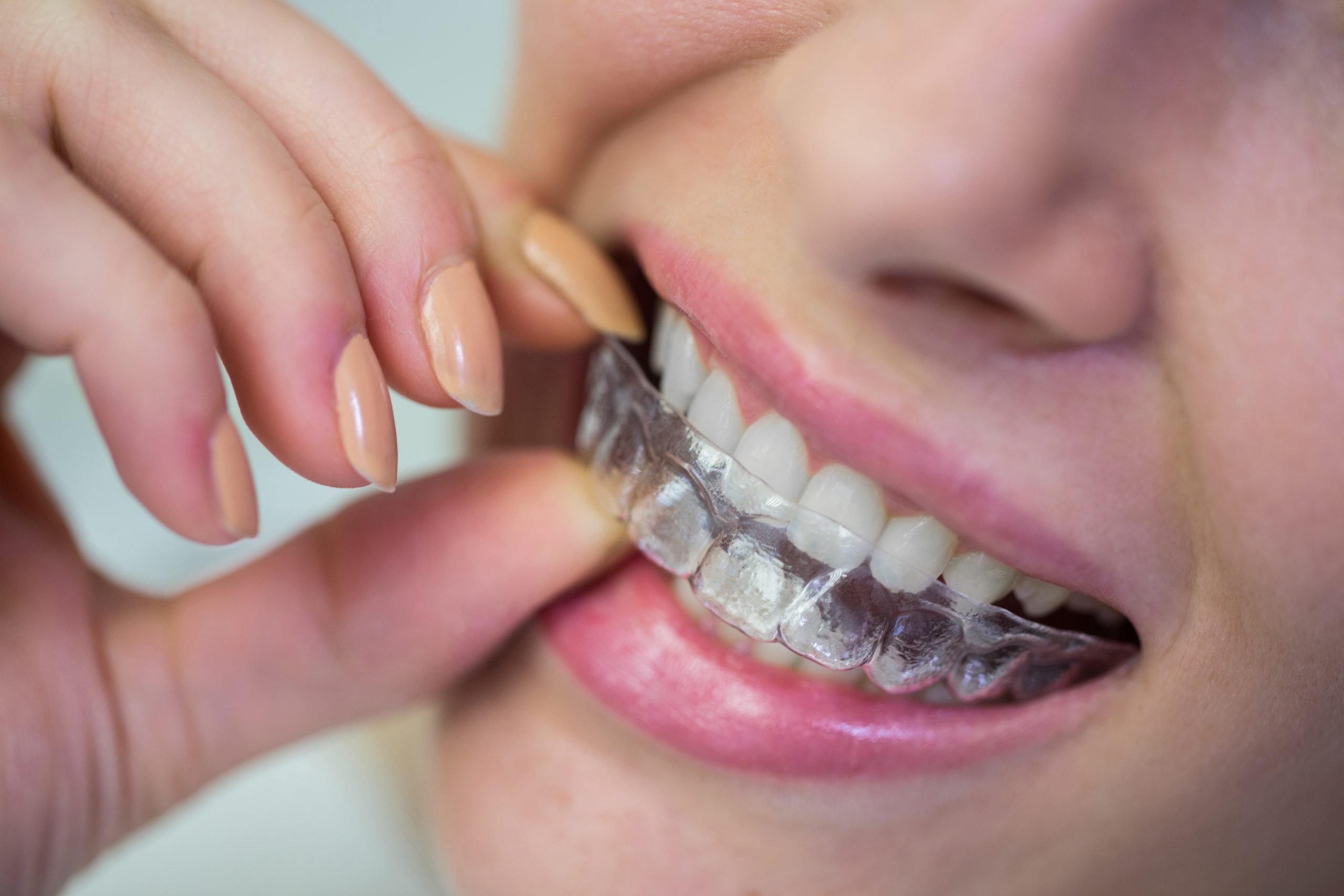 Woman inserting clear aligner tray into mouth to show invisible orthodontic braces