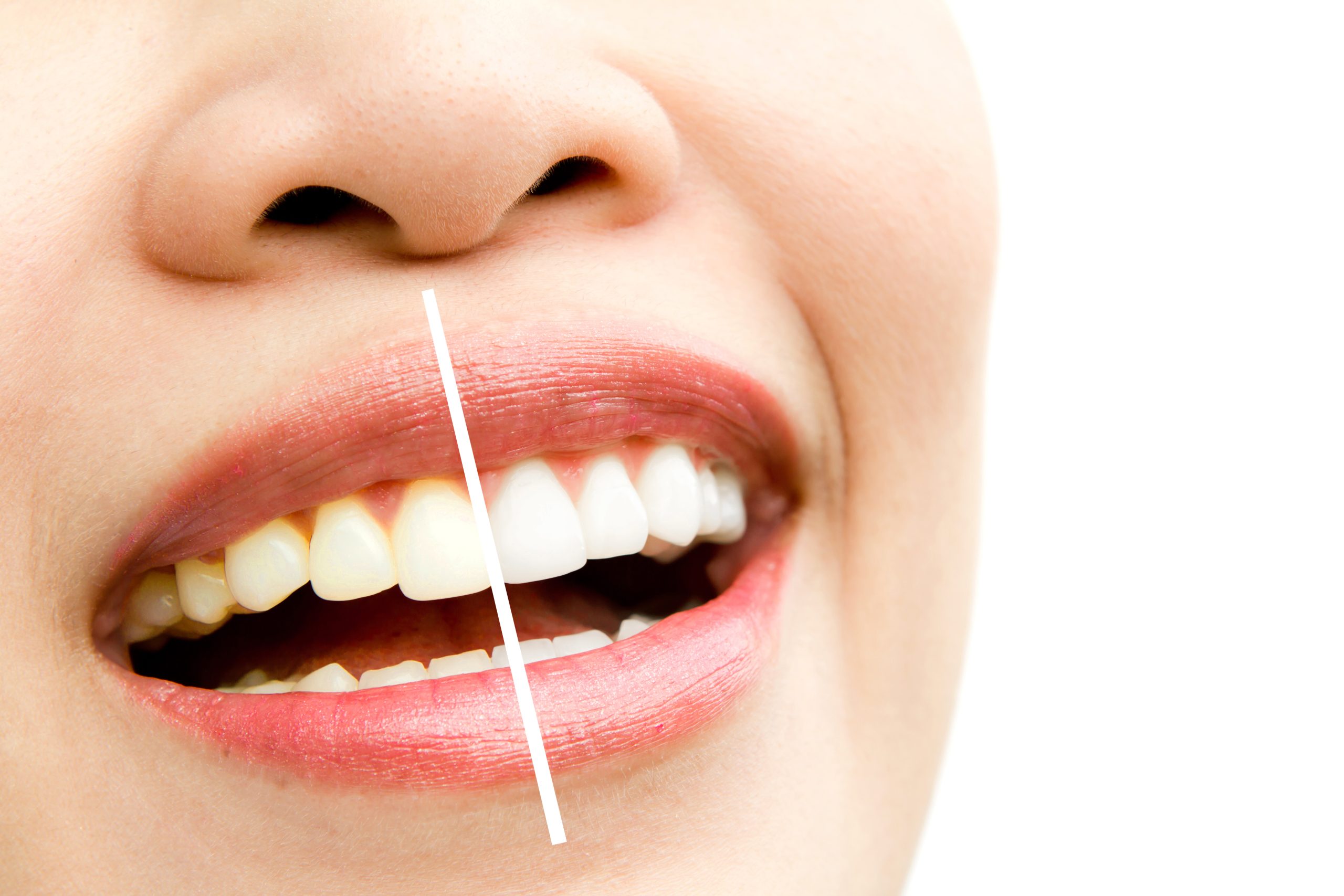 Side-by-side comparison of woman's smile showing teeth whitening results, darker shade on left, brighter on right
