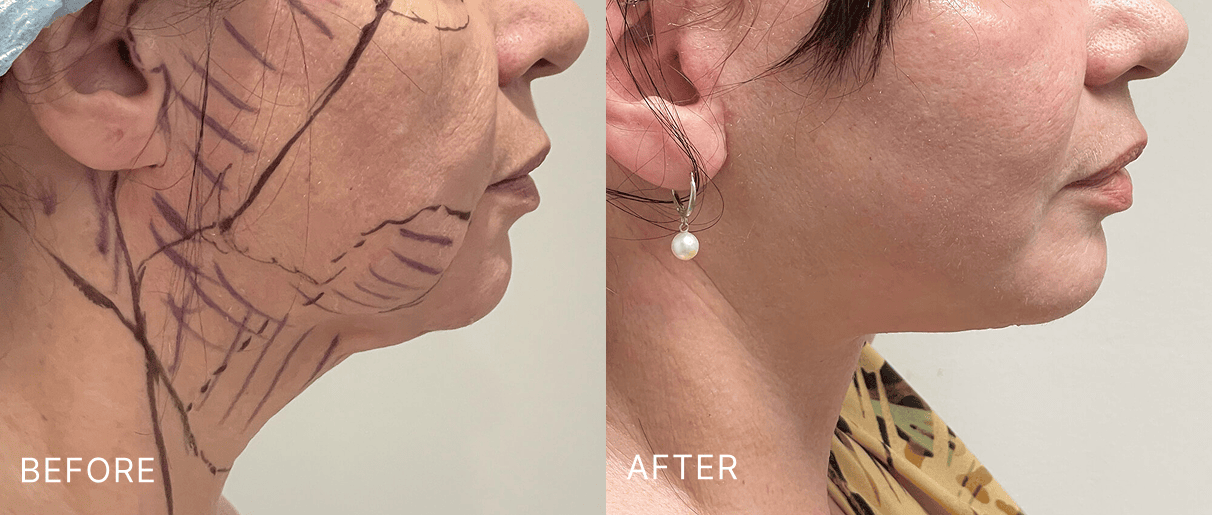 Before and after side profile showing improved neck contour and jawline definition with surgical markings visible on before image