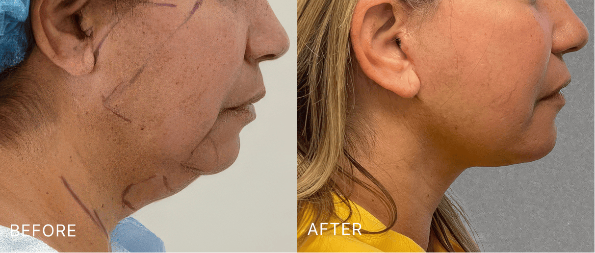 Before and after side profile showing improved jawline and reduced neck laxity