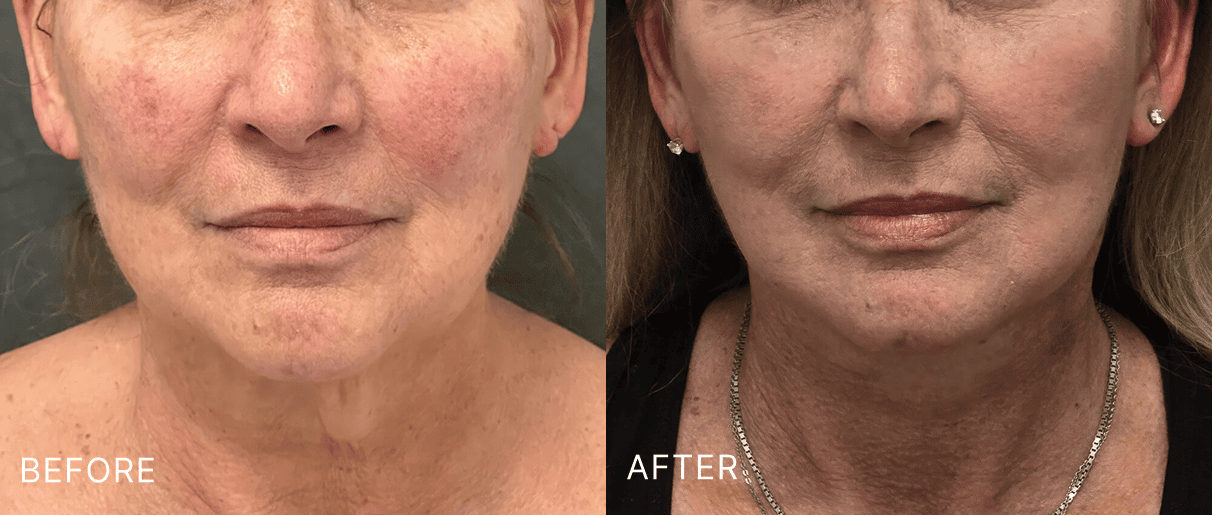 Before and after demonstrating improved facial contours and skin appearance