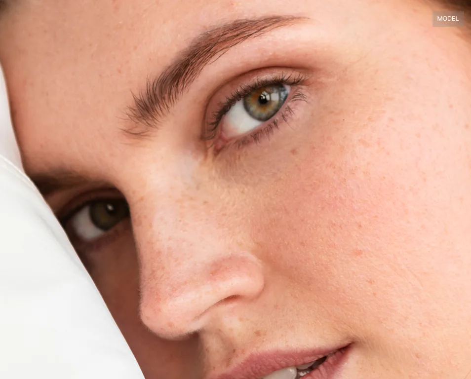 browlift 1 e1786800713597