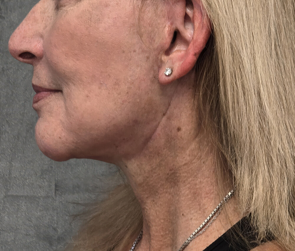 Patient's profile view after deep plane facelift, showing refined jawline and neck definition