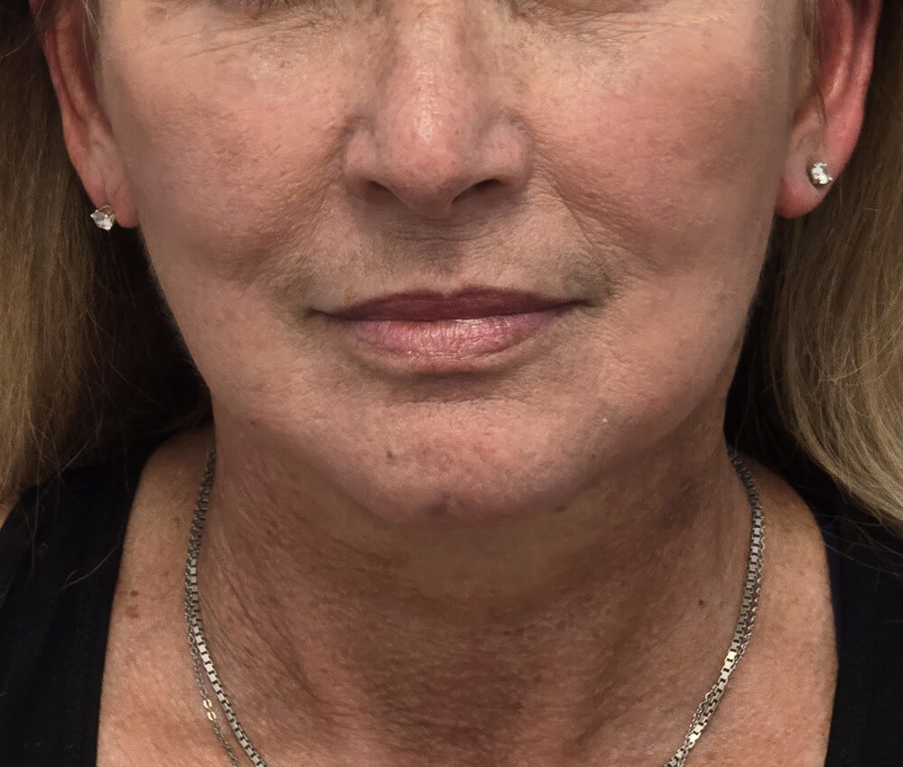 Patient's face after deep plane facelift, showing improved jawline definition and reduced facial sagging