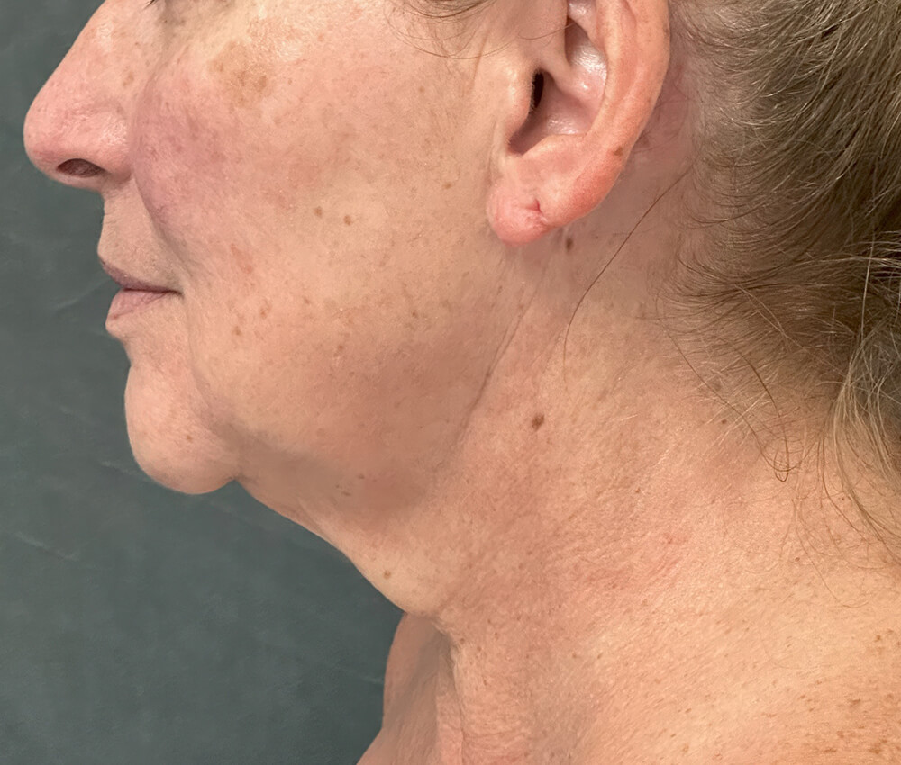 Patient profile before deep plane facelift, showing facial laxity and jowling along jawline