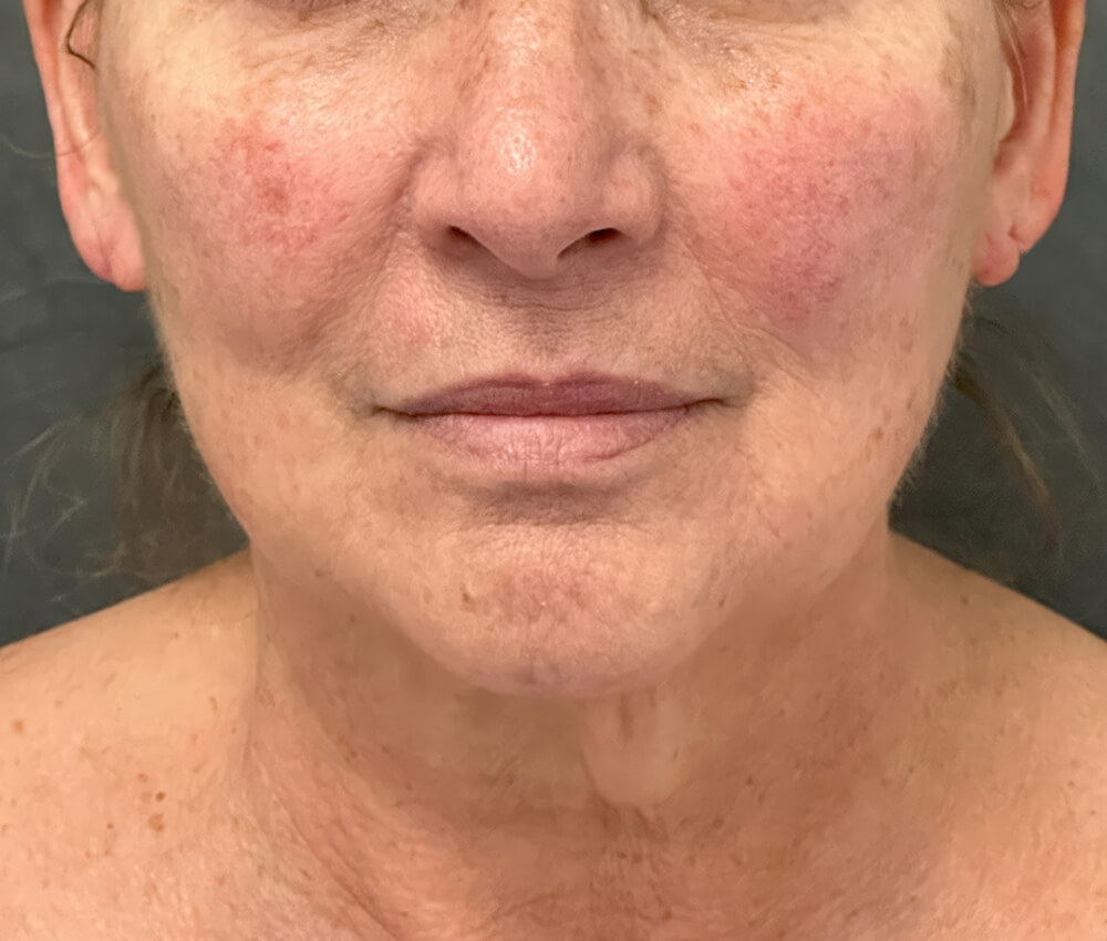 Patient's face before deep plane facelift, frontal view showing facial laxity and wrinkles