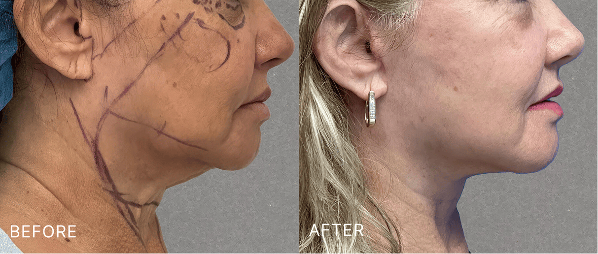 Before and after profile comparison of facelift results with surgical markings visible on before image