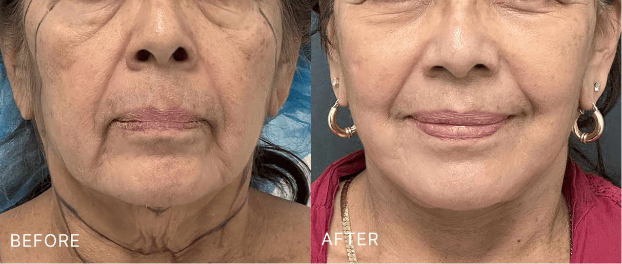 Before and after front-facing views showing improved facial contours and skin texture
