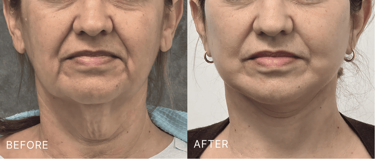 Before and after facial comparison showing reduced jawline sagging and improved neck definition