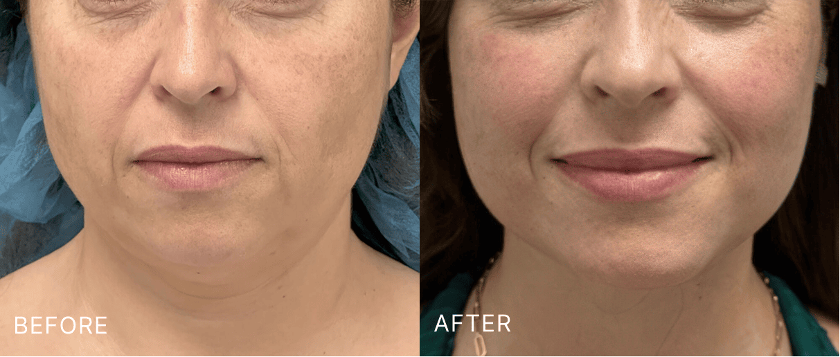 Before and after front-facing views showing improved midface and skin quality