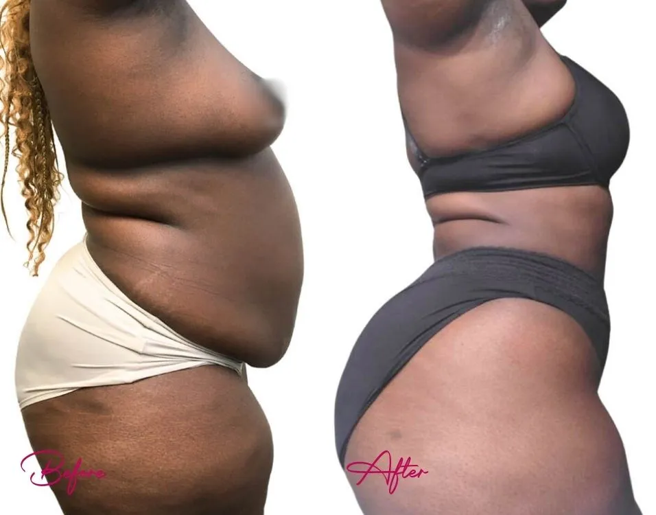 Before and after side profile showing reduced midsection and enhanced body contour from awake liposuction