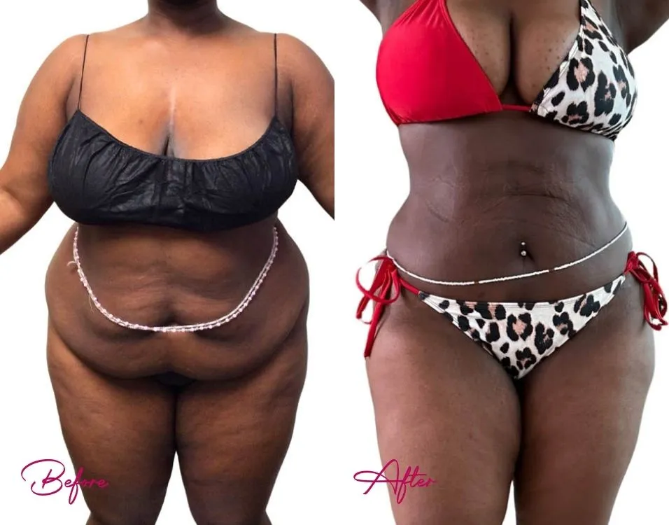 Before and after frontal view showing sculpted abdomen and improved waist definition from awake liposuction