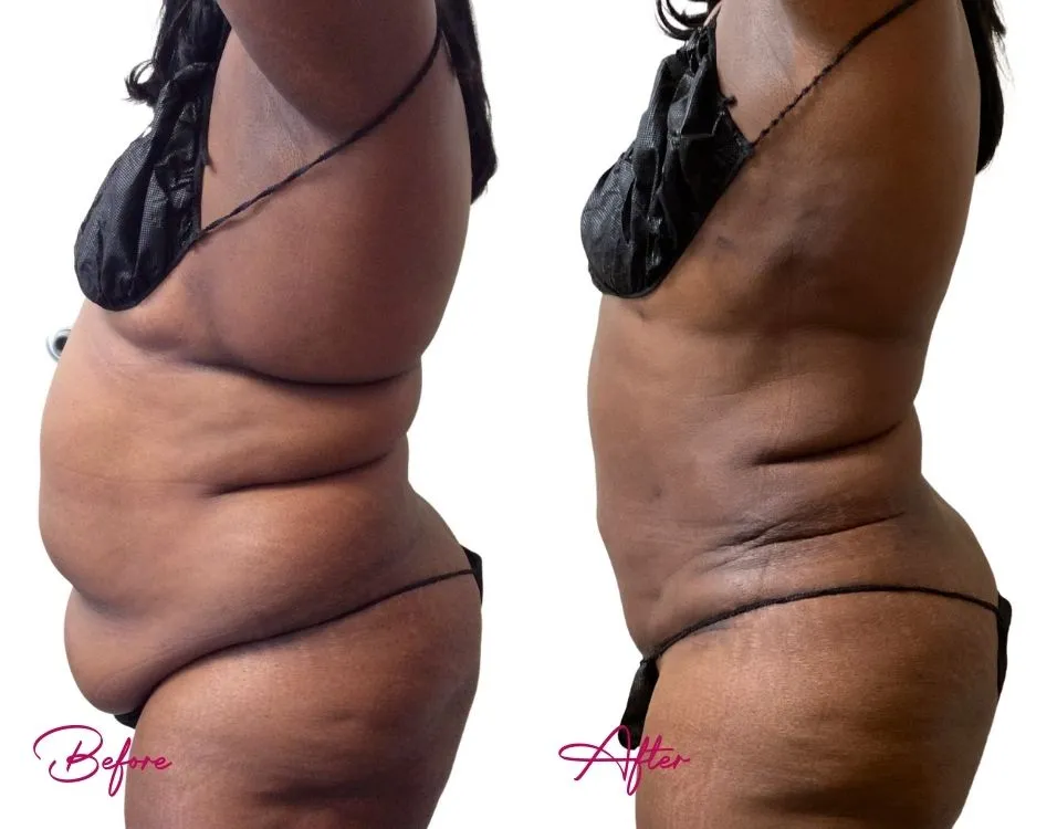 Before and after side profile showing decreased abdominal fullness and refined midsection from awake liposuction