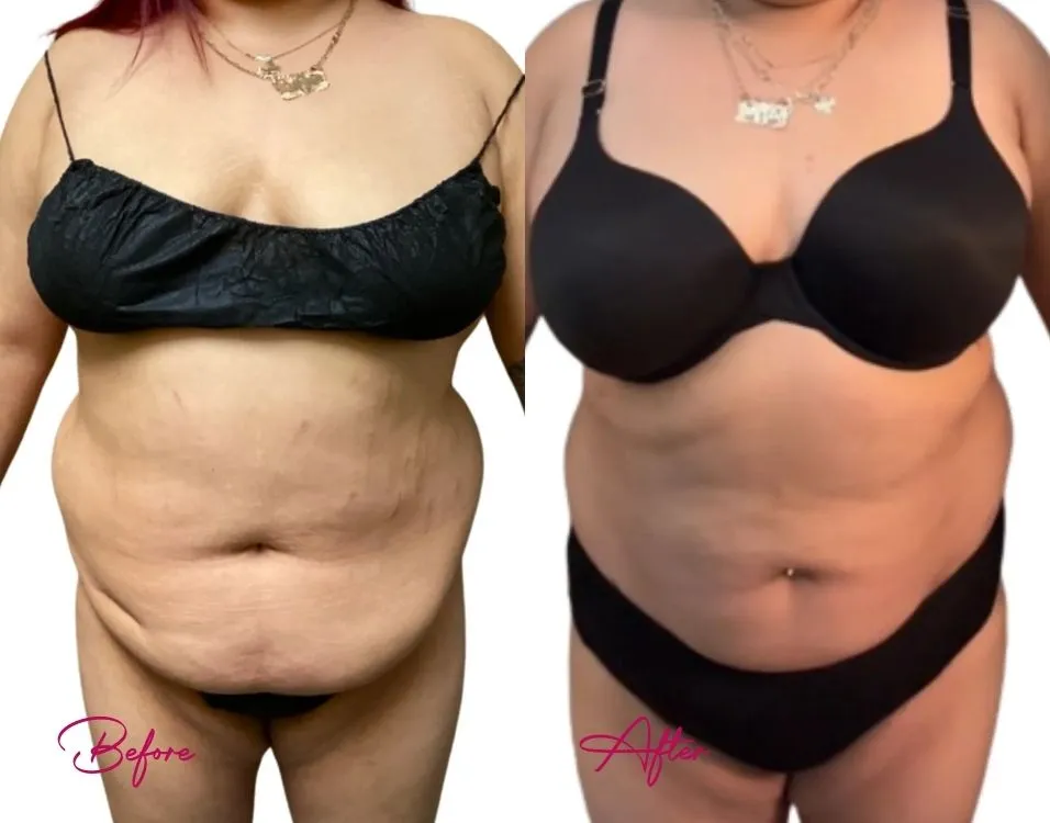 Before and after awake liposuction: abdomen and flanks, frontal view