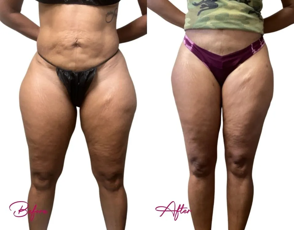 Before and after awake liposuction: abdomen, flanks, and thighs, frontal view