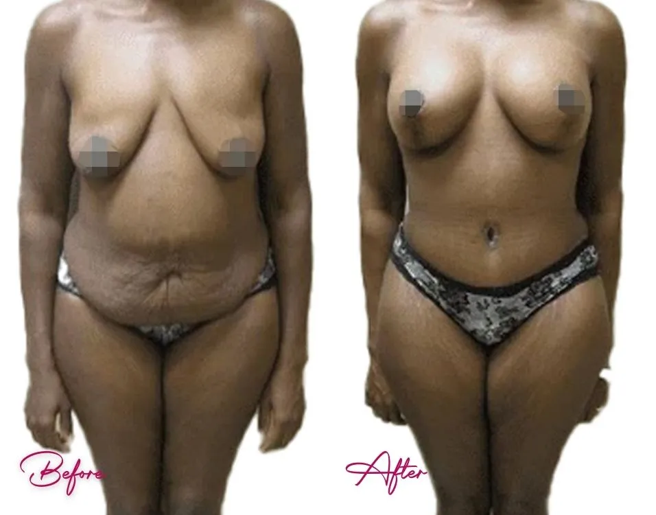 Before and after tummy tuck case 11: front view showing abdominal tightening and contouring