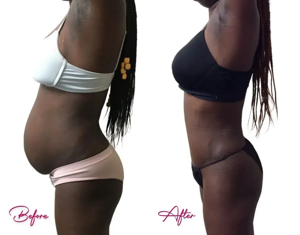 Before and after tummy tuck case 12 showing abdominal contouring results