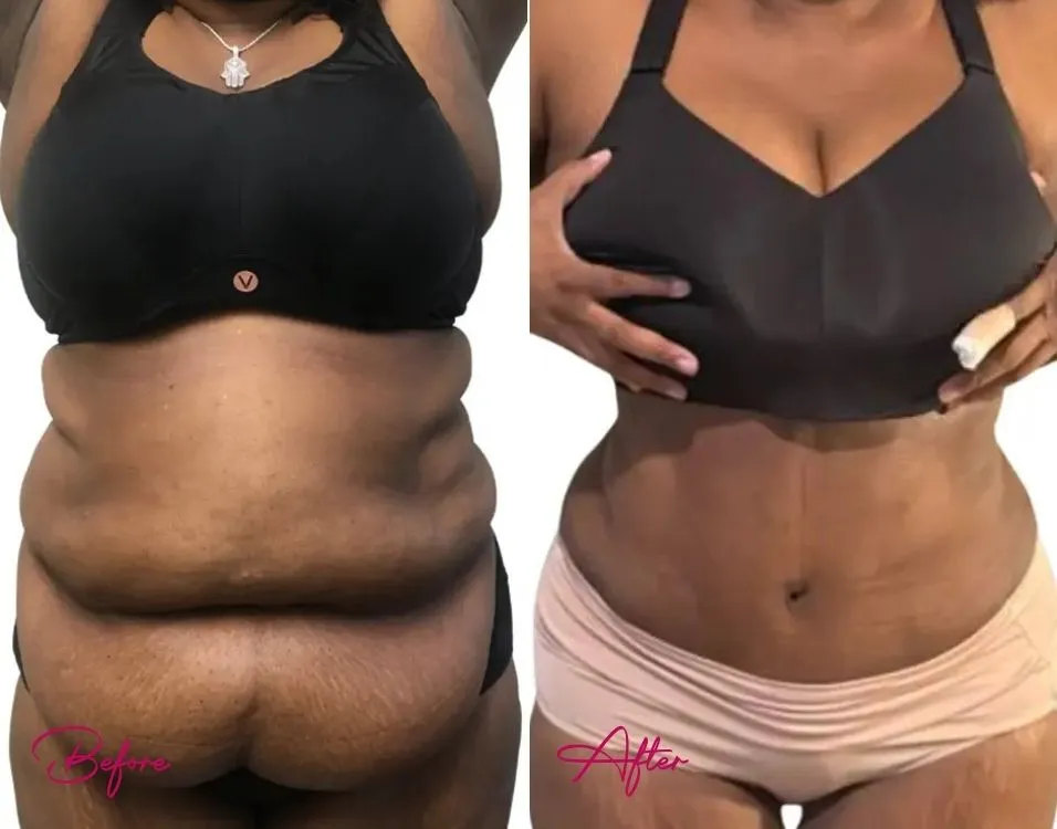 Before and after tummy tuck case 13 showing abdominal and torso contouring