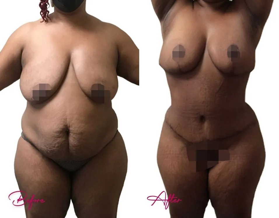 Before and after tummy tuck case 14 showing full body contouring results