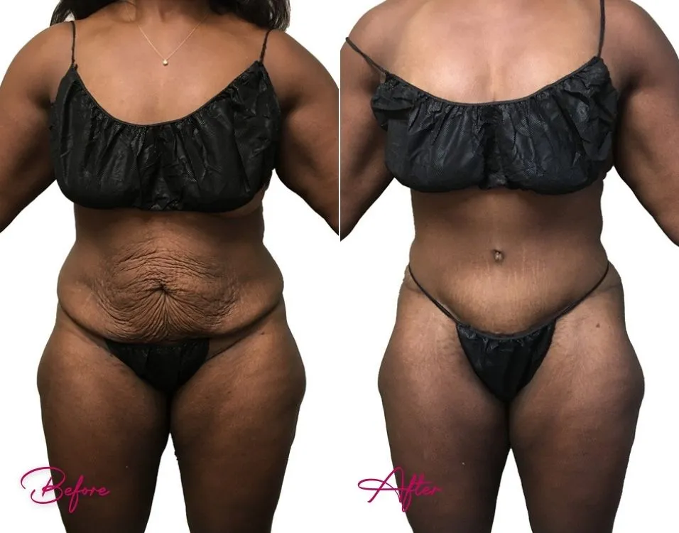 Before and after tummy tuck case 15 showing abdominal skin tightening